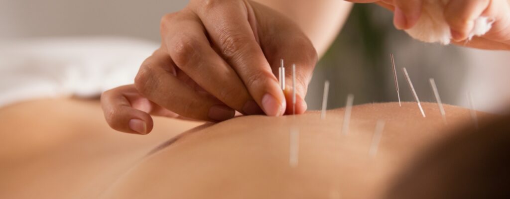 acupuncture-activeCARE-physio-and-sports-medicine-orleans-kanata-barrhaven-montfort-ON