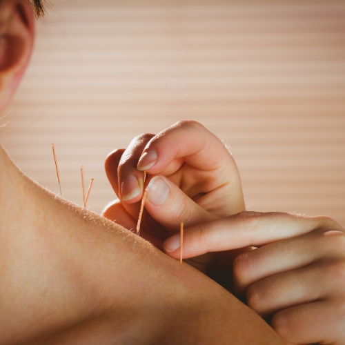 acupuncture-activeCARE-physio-and-sports-medicine-orleans-kanata-barrhaven-montfort-ON